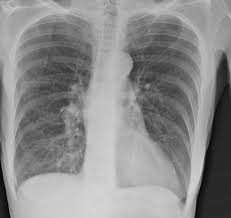 Картинки по запросу "емфізема легень"