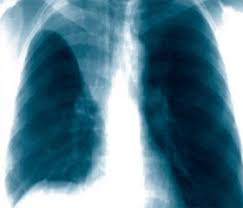 Картинки по запросу "ателектаз легкого при ТБ"