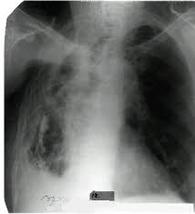 Картинки по запросу "цироз легкого при ТБ"