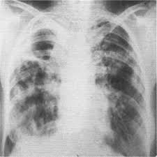 Картинки по запросу "Фиброзно-кавернозній ТБ рентген"