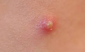 Calayan Skin Clinic - What to know about PUSTULES What CAUSES pustules? A  CLOGGED PORE is the root cause of a pustule. A clogged pore is the root  cause of any PIMPLE,