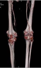 Peripheral Vascular Disease (PVD) with Left Superficial Femoral Artery  (SFA) Occlusion: https://www.ctisus.com/teachingfiles/vascular/431534