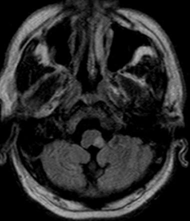Lateral medullary syndrome | Radiology Reference Article | Radiopaedia.org