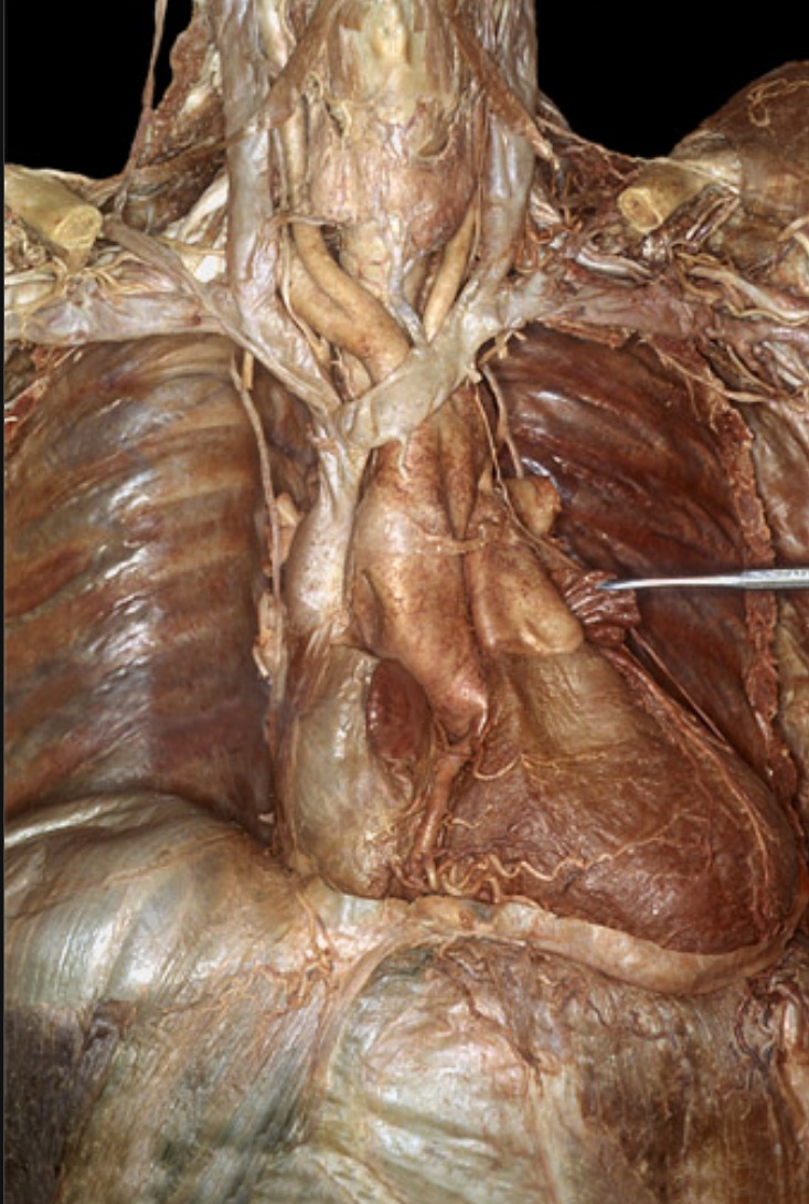 heart donor specimen anterior view
