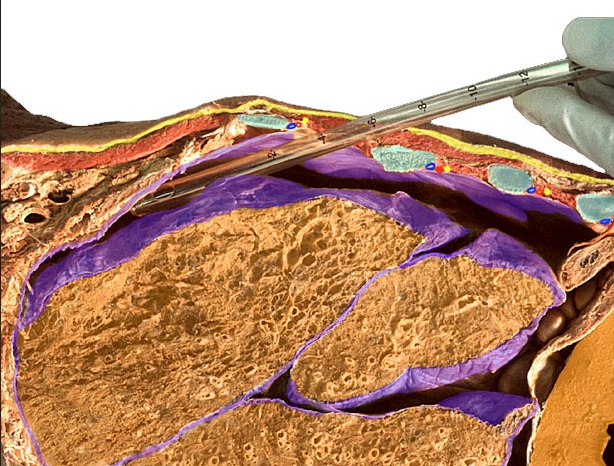 thorax image for intercostal catheterisation