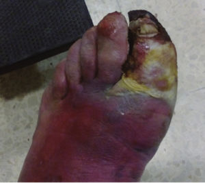 Gangrena gaseosa como presentación de una diabetes mellitus - FMC.  Formación Médica Continuada en Atención Primaria
