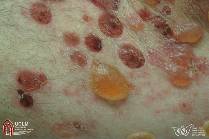 Lesiones de pemfigo