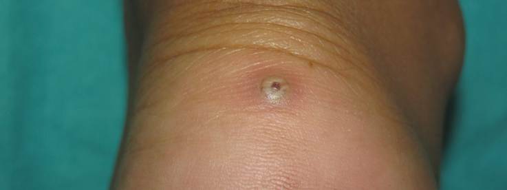 La tungiasis – Guillermo Solano-López