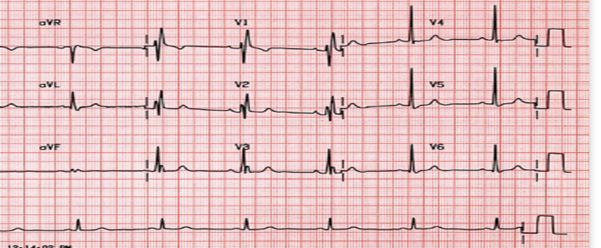 ECG