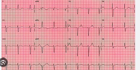 ecg