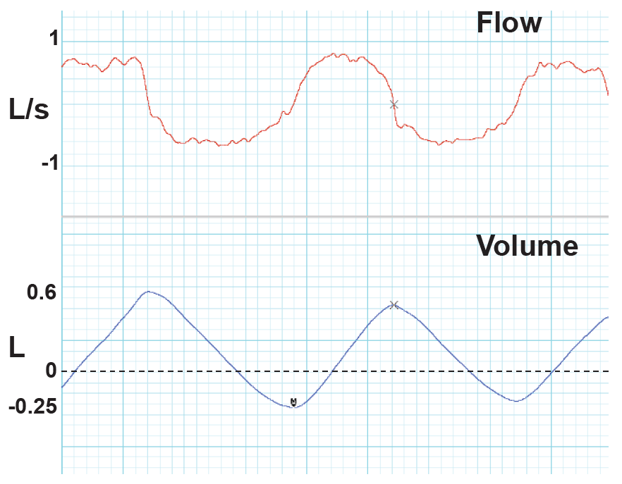 Flow-Volume trace