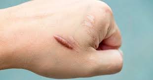 Medidas clave para prevenir la formación de queloides