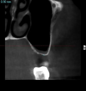 0.7 mm available bone under the sinus before treatment. It is a CBCT view.