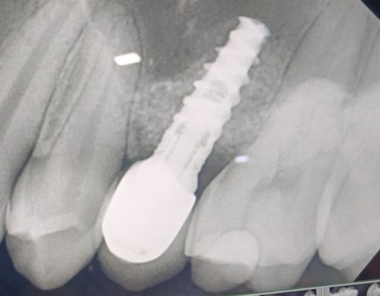 IOP is showing stable bone levels post-operative four years 