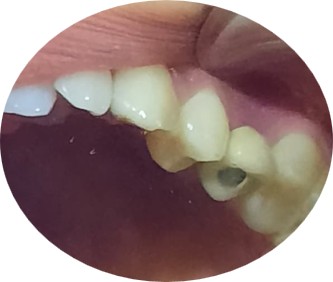 Four-year post-operative view with stable aesthetic results and perfect function.