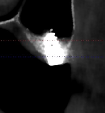 xray photo — Indirect sinus lift in 0.7 mm of bone under the sinus — Sai Smile Dental Care Clinic