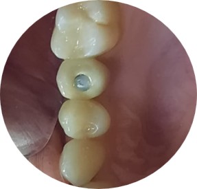 extra photo — Indirect sinus lift in 0.7 mm of bone under the sinus — Sai Smile Dental Care Clinic