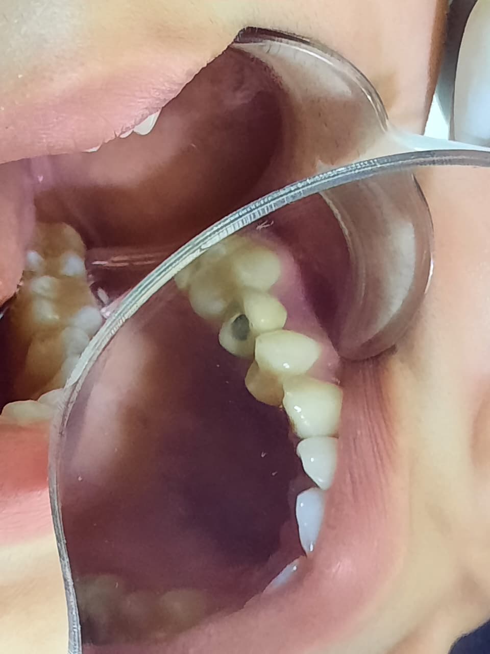 extra photo — Indirect sinus lift in 0.7 mm of bone under the sinus — Sai Smile Dental Care Clinic