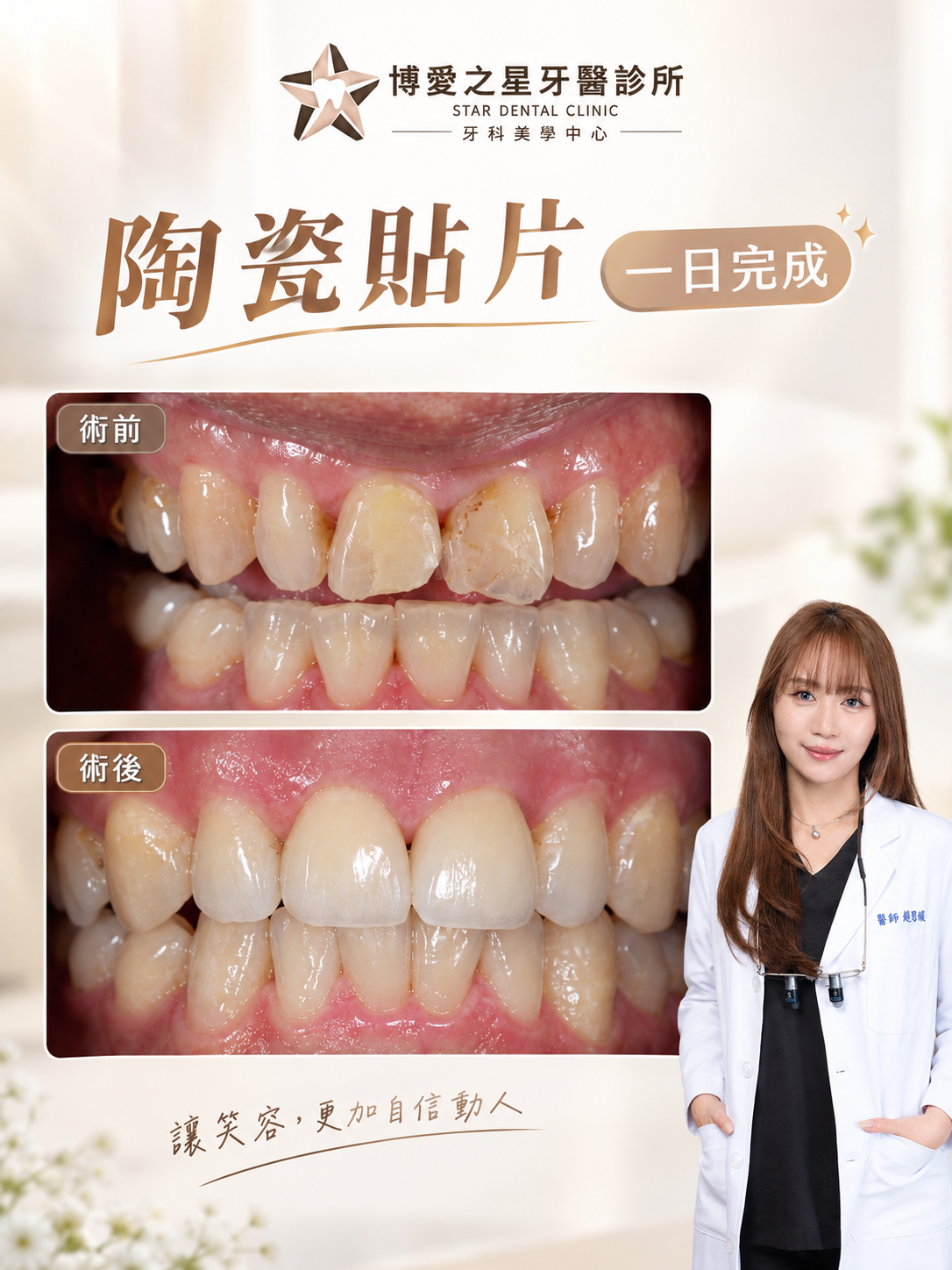 🦷「一日陶瓷貼片」當天拯救變色與微裂痕，找回晶透自信笑顏！🦷