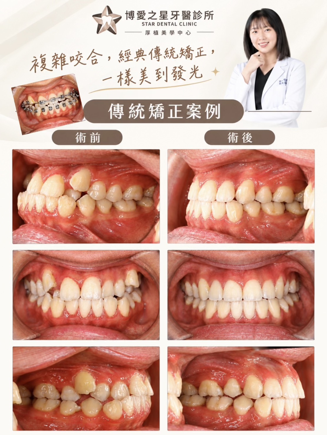 【挑戰高難度錯咬！告別牙齒打架，牙齒界的「控球大師」帶他完美畢業！🦷✨】