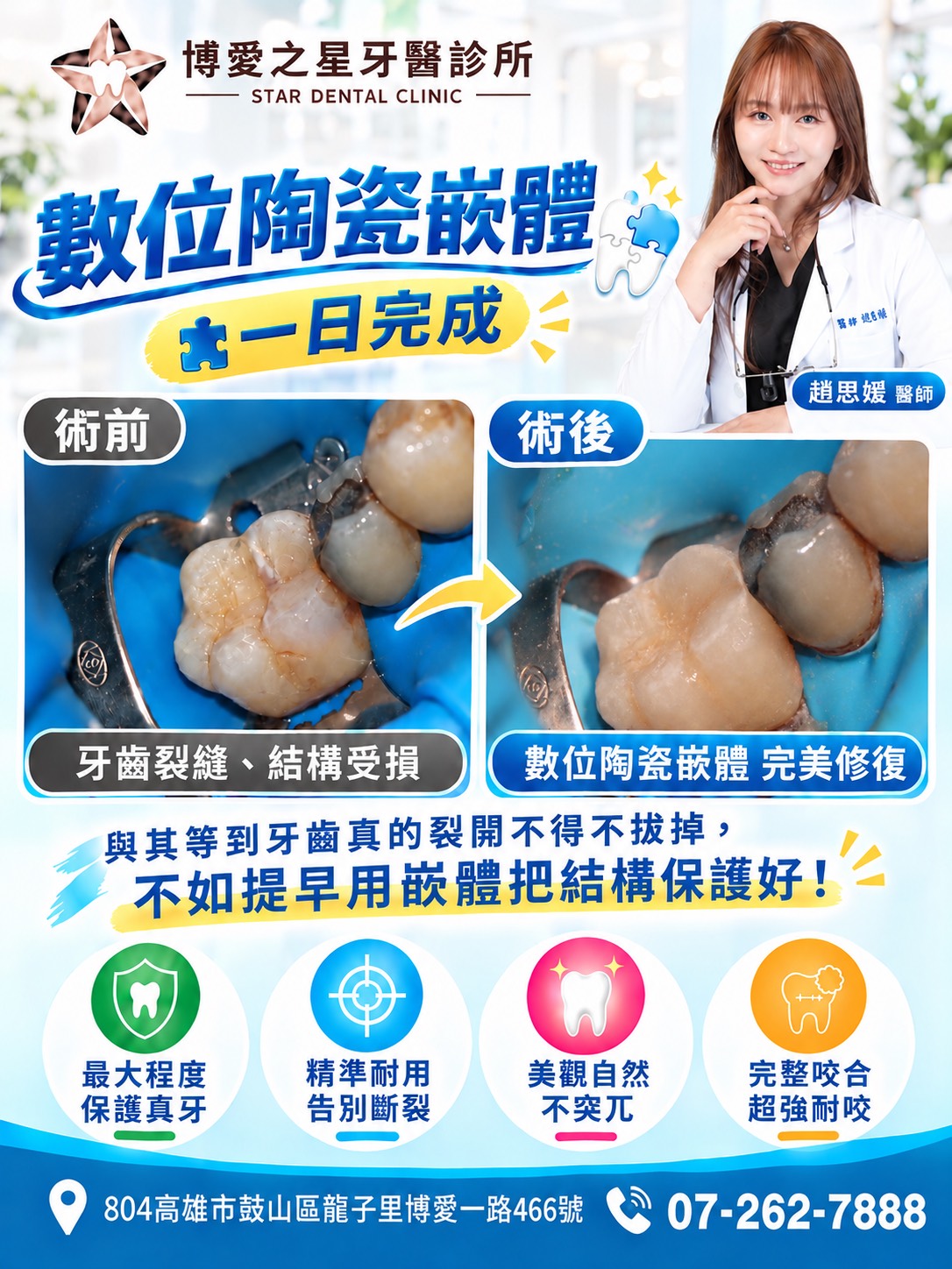 拒絕反覆補牙！陶瓷嵌體告別斷裂危機，留住珍貴真牙
