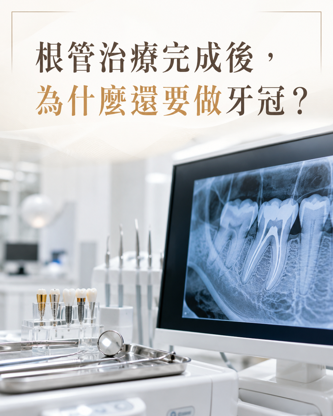 根管治療完成後，為什麼還要做牙冠？從機率與費用看懂這道手續