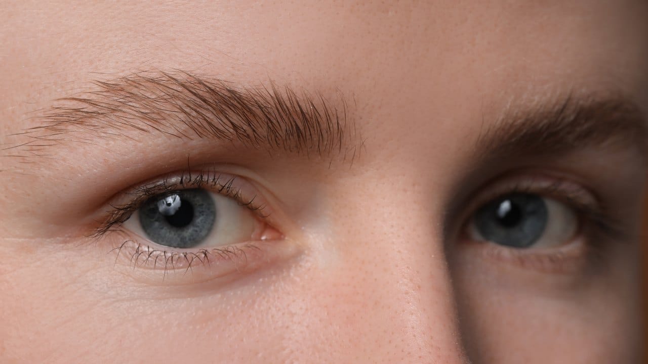 Brow Lift