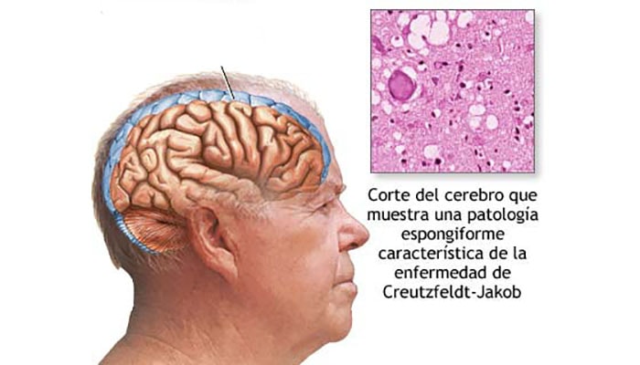 Enfermedad de Creutzfeldt-Jakob