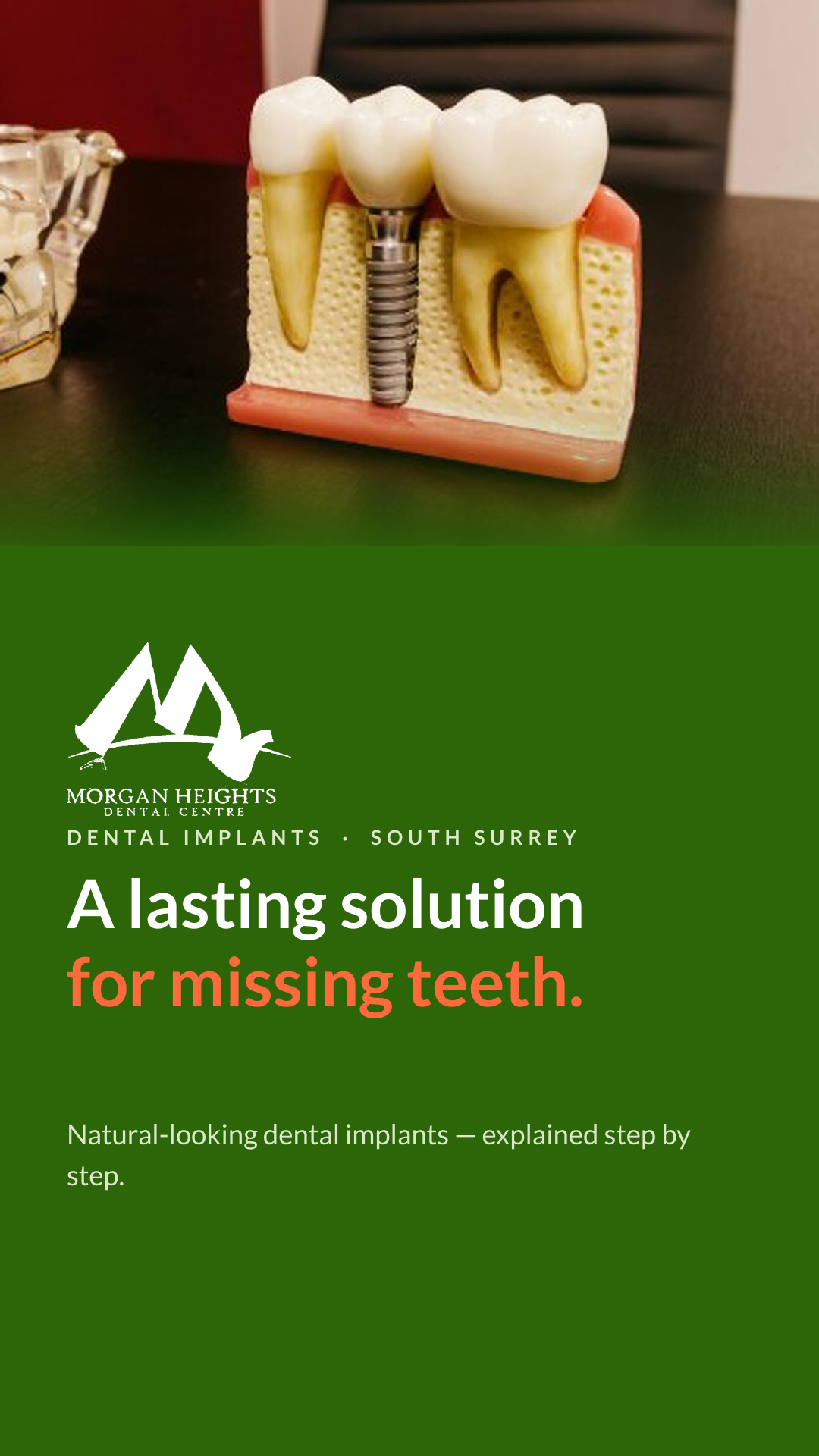 Dental Implants- A lasting solution to a missing teeth