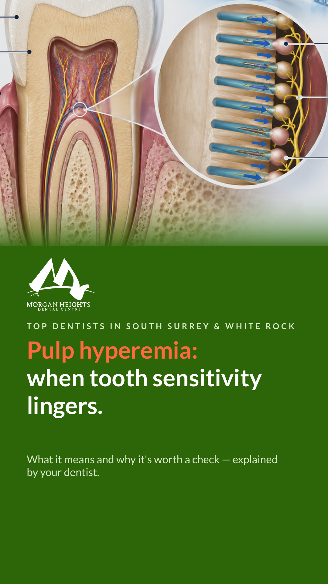 Pulp hyperemia- when tooth sensitivity lingers.