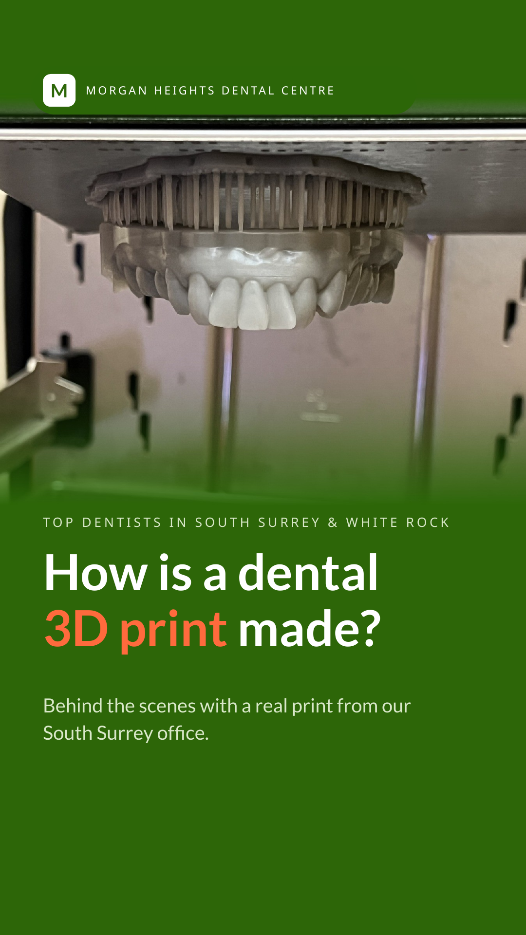 How is a dental 3D print made-