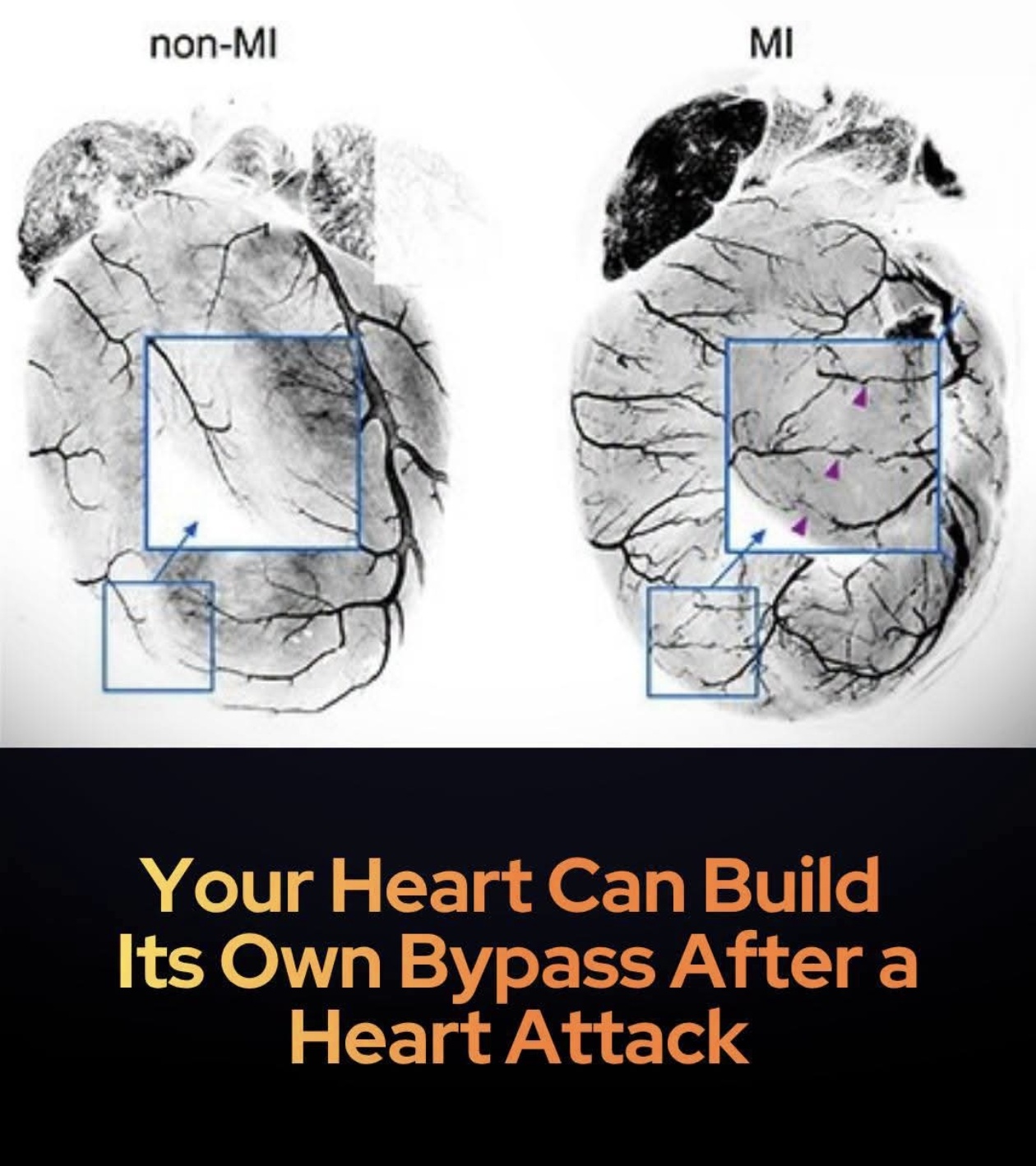 How the Heart Builds Its Own Natural Bypasses