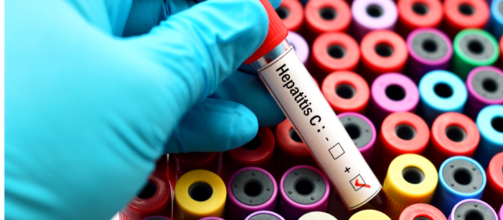 How Hepatitis C Infection Is Diagnosed? - DoctorOnCall