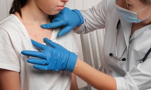 Chickenpox Vaccine Malaysia: Benefits and Side Effects - DoctorOnCall
