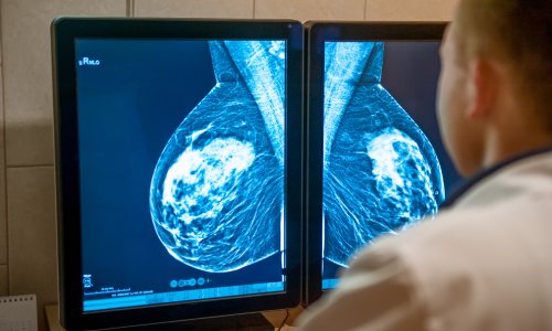 Stage 4 Metastatic Breast Cancer: Overlooked Real Symptoms | DoctorOnCall