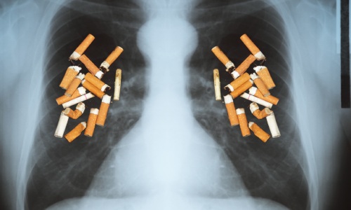 Lung Cancer Causes: Know Your Risk! | DoctorOnCall