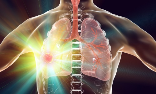 Diagnosing Lung Cancer: Doctor's Best Method | DoctorOnCall