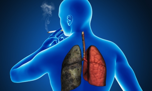 Lung Cancer: Can Be Treated Even At Stage 4 | DoctorOnCall