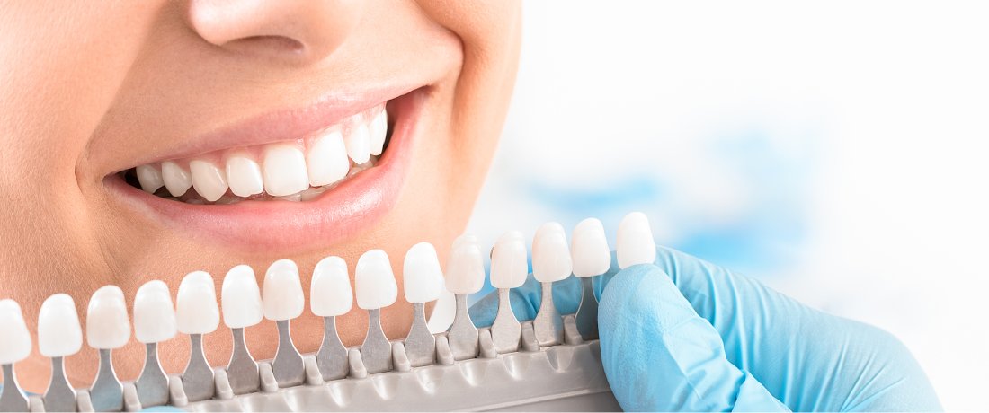 Teeth Whitening In Malaysia - Prices And Your Options - DoctorOnCall