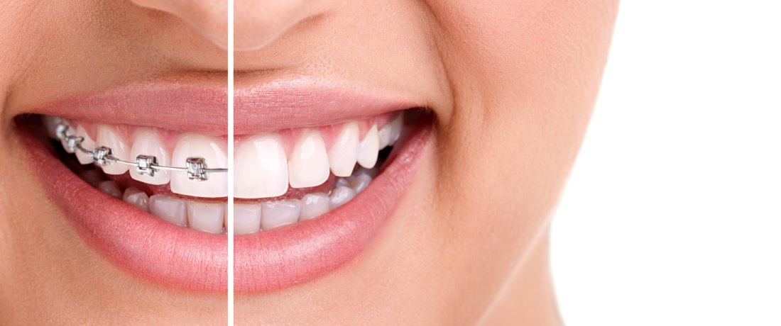 Dental Braces In Malaysia - Prices, Types & Where To Get - DoctorOnCall