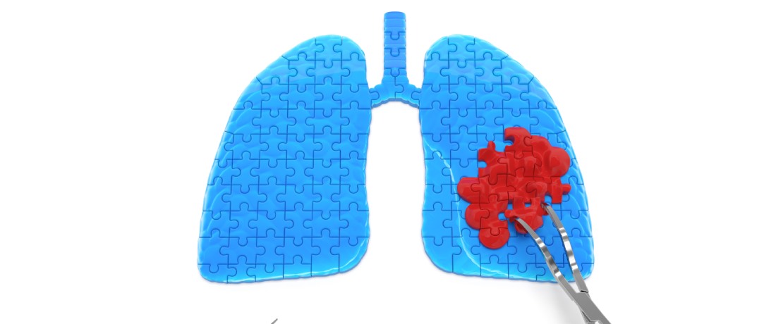 Double Lung Transplant: What, How & When | DoctorOnCall