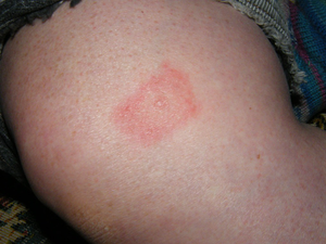 Lyme disease