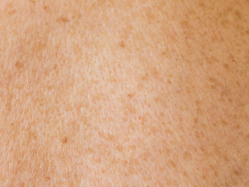 Human skin texture with freckles