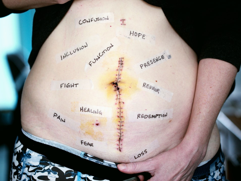 We did an empowering photo of her scar today with words taped around the scar. These words are her words to own. She chose each word. We can empathize, but we will never feel what she feels, we can imagine, but this is her pain, her recovery, her healing journey. She had right hemicolectomy surgery to remove a bit of small intestine, appendix, cecum, a huge mass they found in her cecum, her ascending colon, and a bit of her transverse colon. She has suffered from Crohn’s disease for almost 10 years.