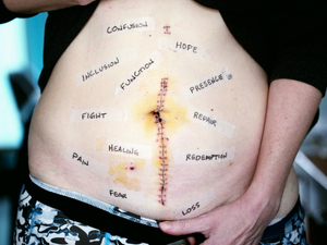 We did an empowering photo of her scar today with words taped around the scar. These words are her words to own. She chose each word. We can empathize, but we will never feel what she feels, we can imagine, but this is her pain, her recovery, her healing journey. She had right hemicolectomy surgery to remove a bit of small intestine, appendix, cecum, a huge mass they found in her cecum, her ascending colon, and a bit of her transverse colon. She has suffered from Crohn’s disease for almost 10 years.