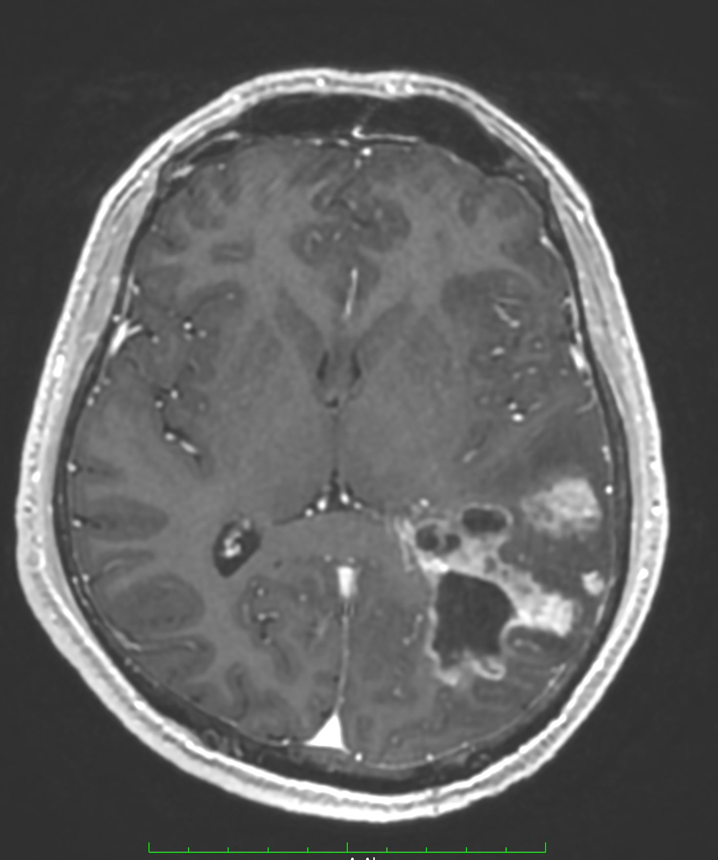 glioblastoma ameliyatı