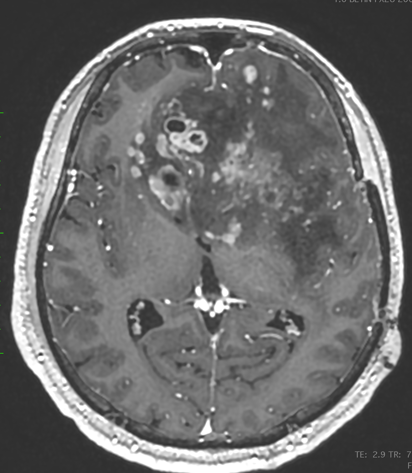 Glioblastoma Neden Tekrarlar? Nüks Tedavisi