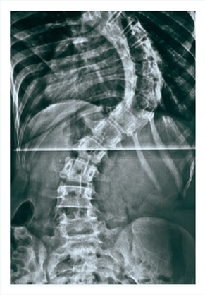 Radiografia de coluna