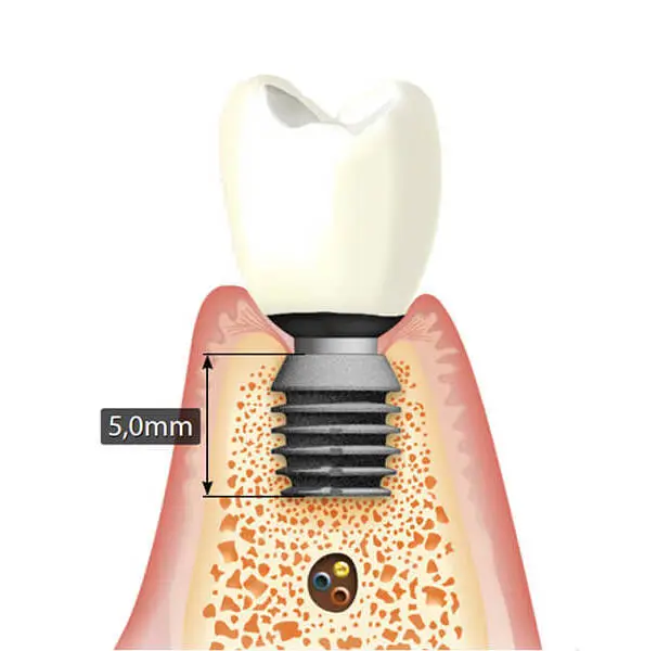 bicon short implants