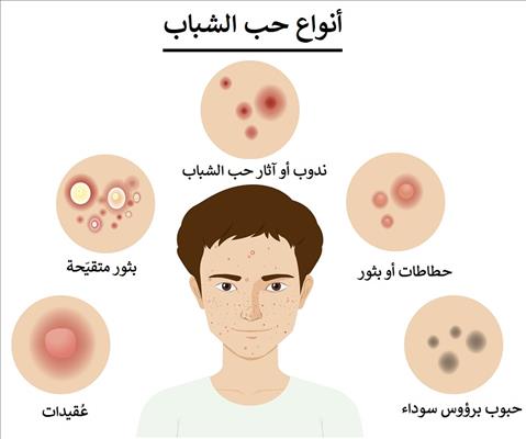 انواع حب الشباب وبعض اسباب ظهور الحبوب